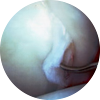 Cartilage Tears